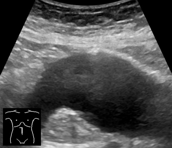Sagittal abdominal aortic aneurysm