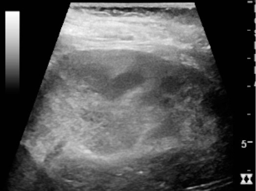 Acute pyelonephritis