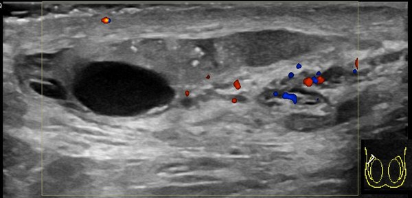 Anechoic cyst at the epididymal head