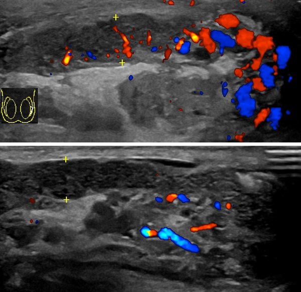 Marked epididymal hyperaemia on colour Doppler