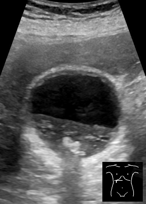 Gallbladder with layering sludge and dependent stones