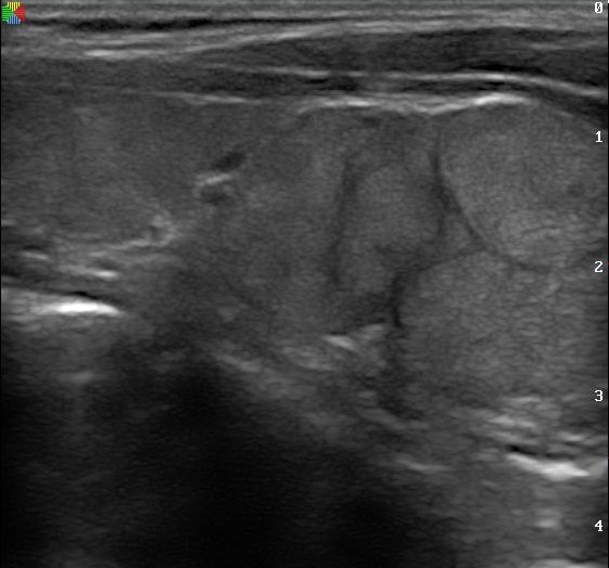 Heterogeneous micronodular thyroid in Hashimoto thyroiditis