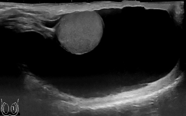 Anechoic fluid surrounding the testis