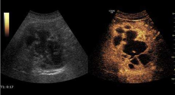 Hepatic abscess on B mode and contrast enhanced ultrasound