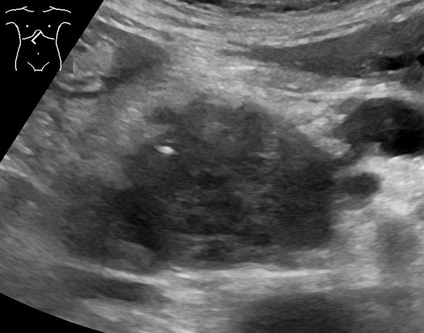 Hypoechoic mass in the pancreatic head