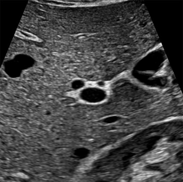 Transverse portal triad ultrasound