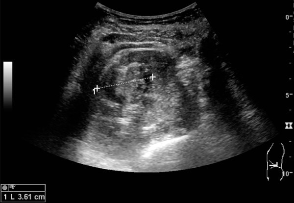 Solid cortical renal mass with calipers