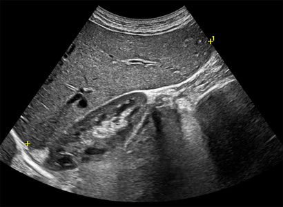 Right lobe echo texture ultrasound